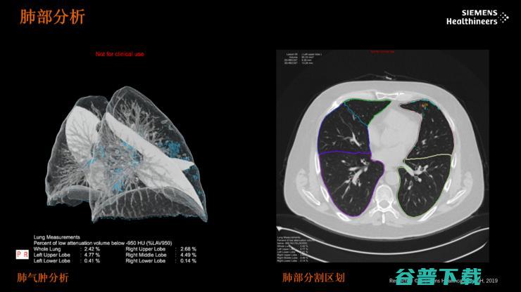 西门子医疗陈黎峰：医疗决策精准化的「痛点」与「突破」| CCF-GAIR 2020