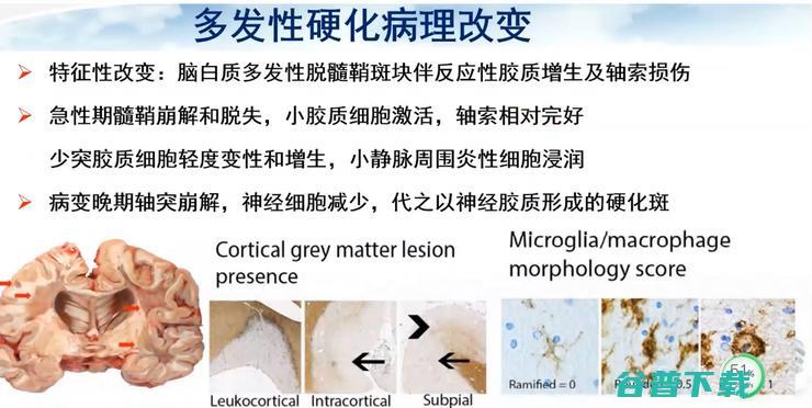 医科大学宣武医院副院长卢洁教授：AI在脑脱髓鞘病MRI中，有哪些应用？｜CMAI 2022