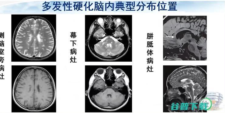 医科大学宣武医院副院长卢洁教授：AI在脑脱髓鞘病MRI中，有哪些应用？｜CMAI 2022