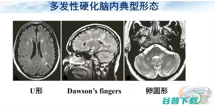 医科大学宣武医院副院长卢洁教授：AI在脑脱髓鞘病MRI中，有哪些应用？｜CMAI 2022