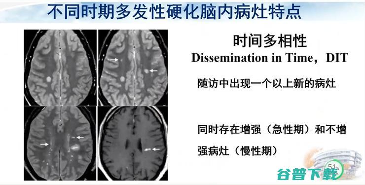 医科大学宣武医院副院长卢洁教授：AI在脑脱髓鞘病MRI中，有哪些应用？｜CMAI 2022