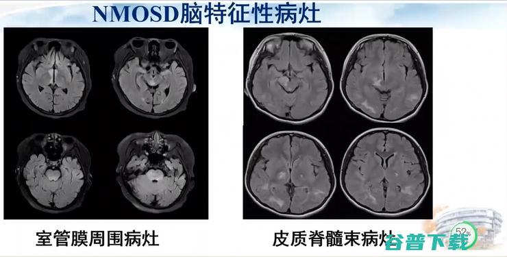 医科大学宣武医院副院长卢洁教授：AI在脑脱髓鞘病MRI中，有哪些应用？｜CMAI 2022