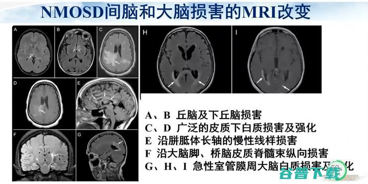 医科大学宣武医院副院长卢洁教授：AI在脑脱髓鞘病MRI中，有哪些应用？｜CMAI 2022