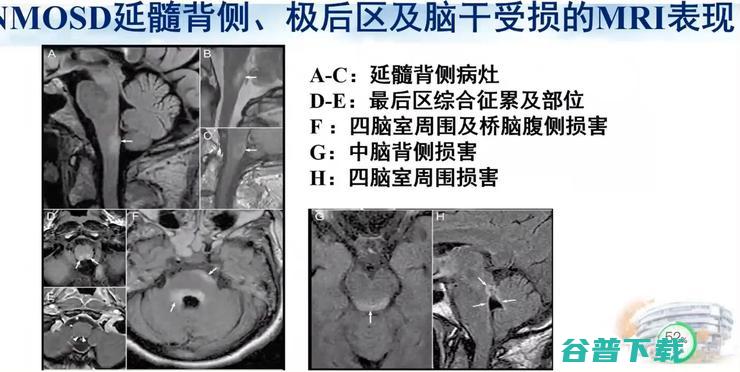 医科大学宣武医院副院长卢洁教授：AI在脑脱髓鞘病MRI中，有哪些应用？｜CMAI 2022