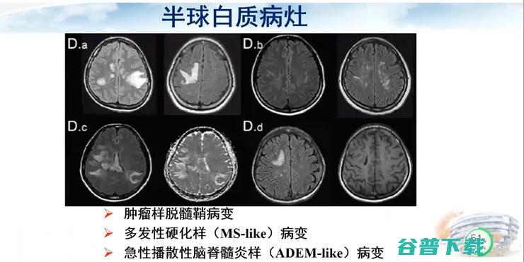 医科大学宣武医院副院长卢洁教授：AI在脑脱髓鞘病MRI中，有哪些应用？｜CMAI 2022