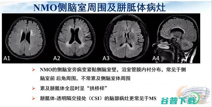 医科大学宣武医院副院长卢洁教授：AI在脑脱髓鞘病MRI中，有哪些应用？｜CMAI 2022