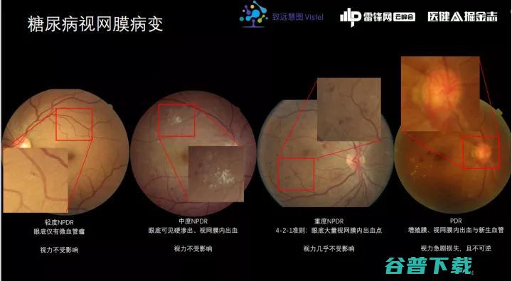 致远慧图CTO丁大勇：找金标准、证明研发价值，糖网AI获批有哪些「第一性原理」？