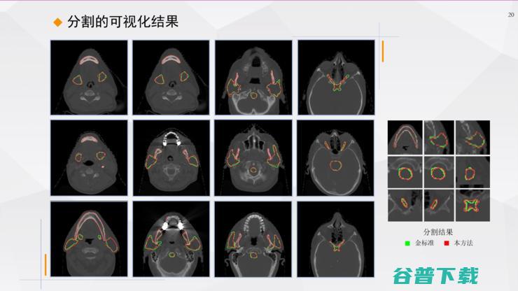 复旦宋志坚教授：深度学习在mpMRI图像处理、医疗数据增强方面的工作心得 | ISICDM 