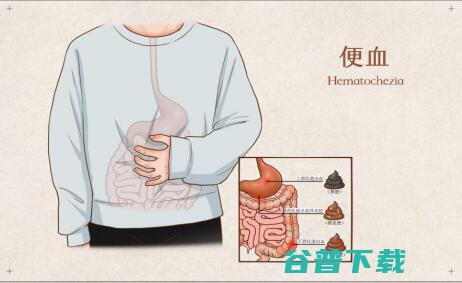 女子便血肠镜检查发现直肠癌 (女子便血肠镜图片)