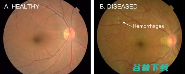谷歌化身眼科专家 用深度学习诊断糖尿病视网膜病变 (谷歌眼睛)
